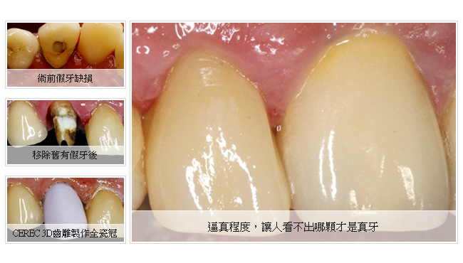 3D微創植牙手術