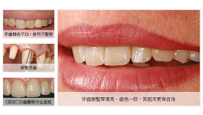 3D齒雕植牙