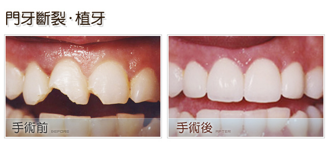 門牙斷裂植牙