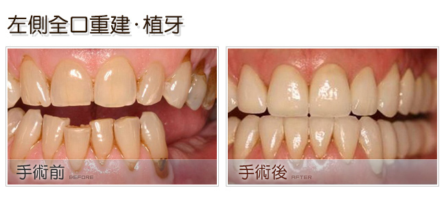 左側全口重建植牙