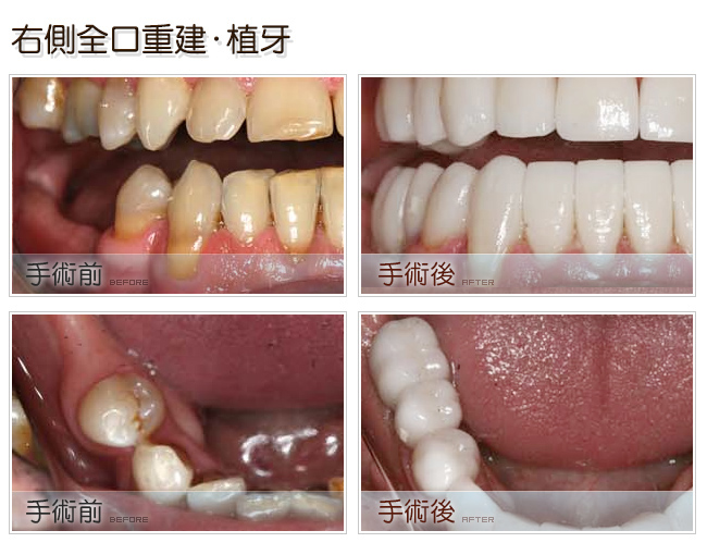 右側全口重建植牙