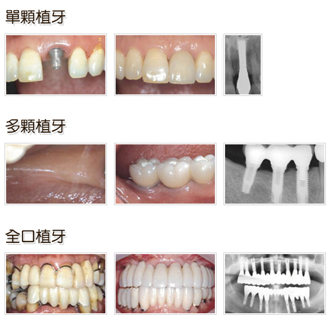 單顆植牙、多顆植牙、全口植牙