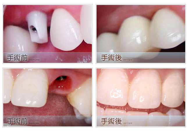 信和美3D植牙技術