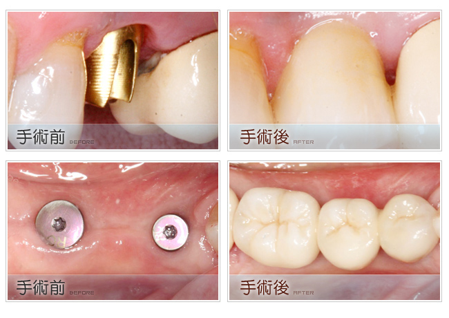 植牙費用及注意事項