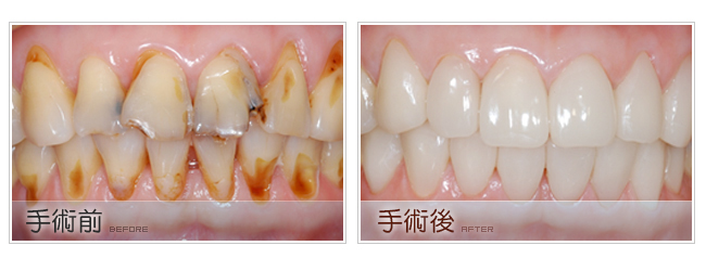 人工植牙的好處