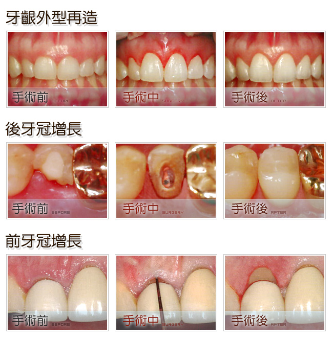 植牙外型再造、前後牙冠增長