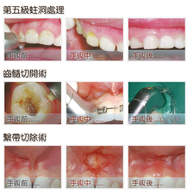 第五集蛀洞處理、齒髓切開術、繫帶切除術